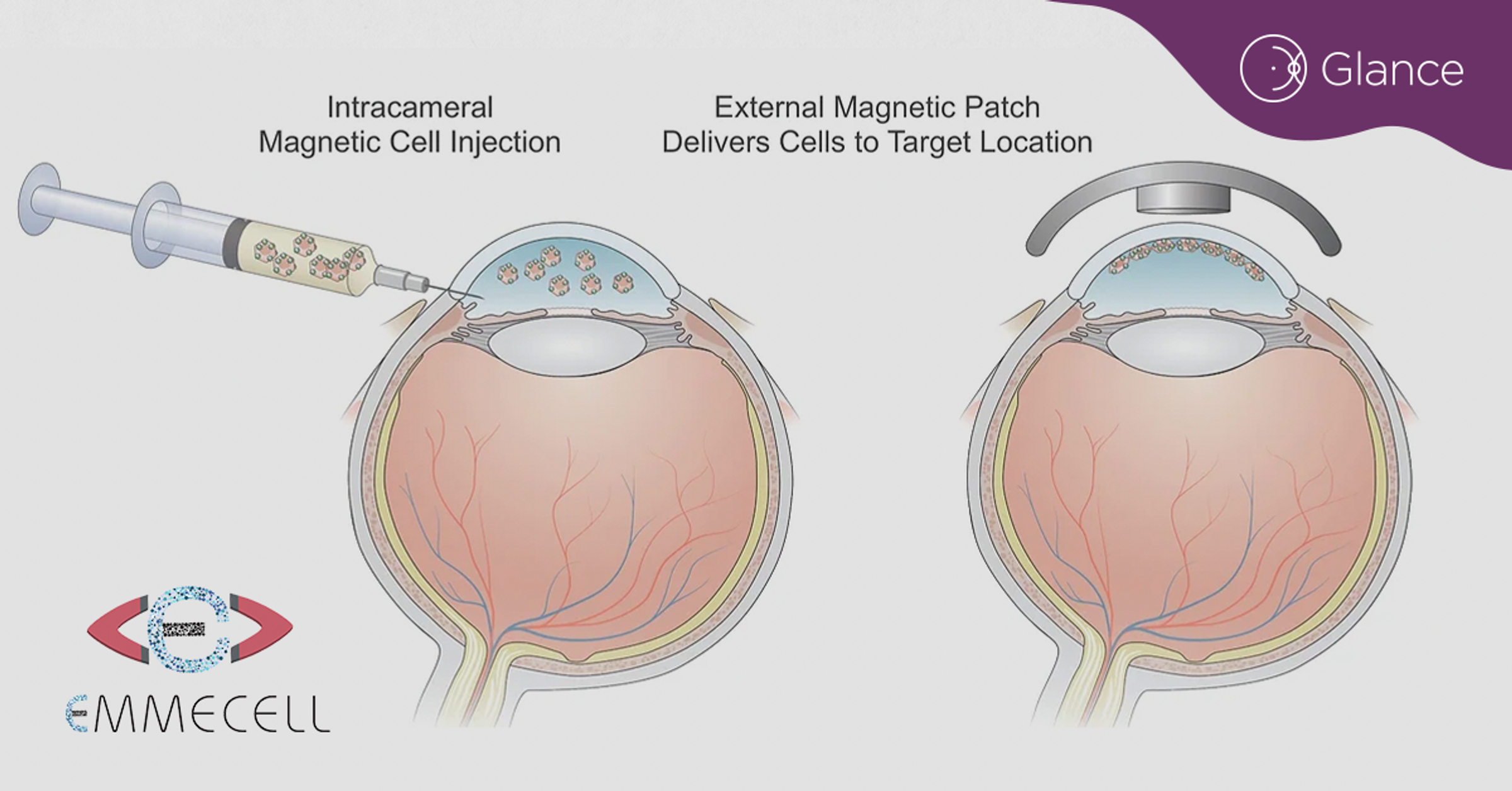 Cell therapy dosing concludes for Emmecell's corneal edema trial