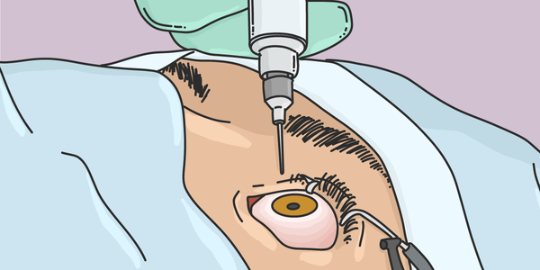 Robot system for wet AMD may lead to fewer injection treatments
