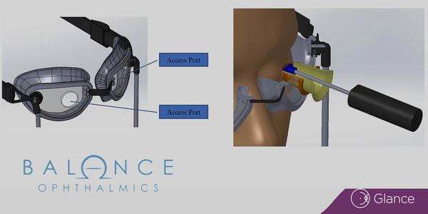 Balance Ophthalmics earns De Novo classification for FSYX IOP device