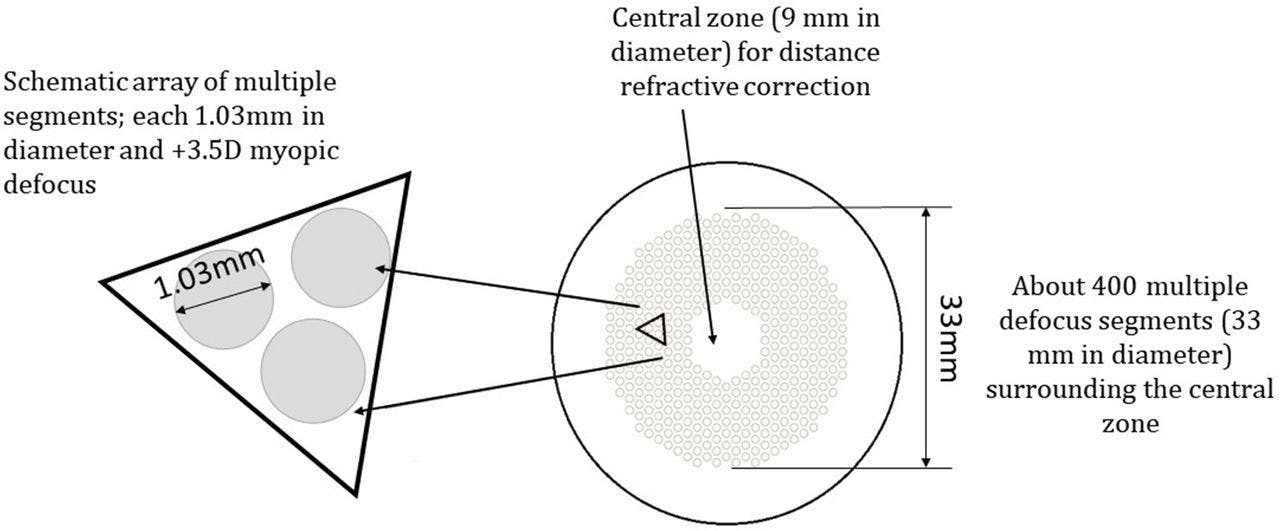 Figure 1. The design of the Defocus Incorporated Multiple Segments (DIMS) spectacle lens.